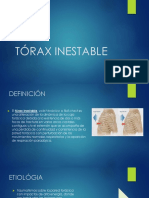 Tórax inestable: definición, etiología, fisiopatología, diagnóstico y tratamiento