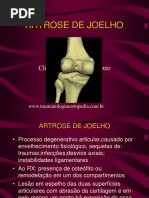Artrose de Joelho