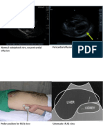 Normal Subxiphoid View, No Pericardial Effusion Pericardial Effusion (Arrowed), Subxiphoid View