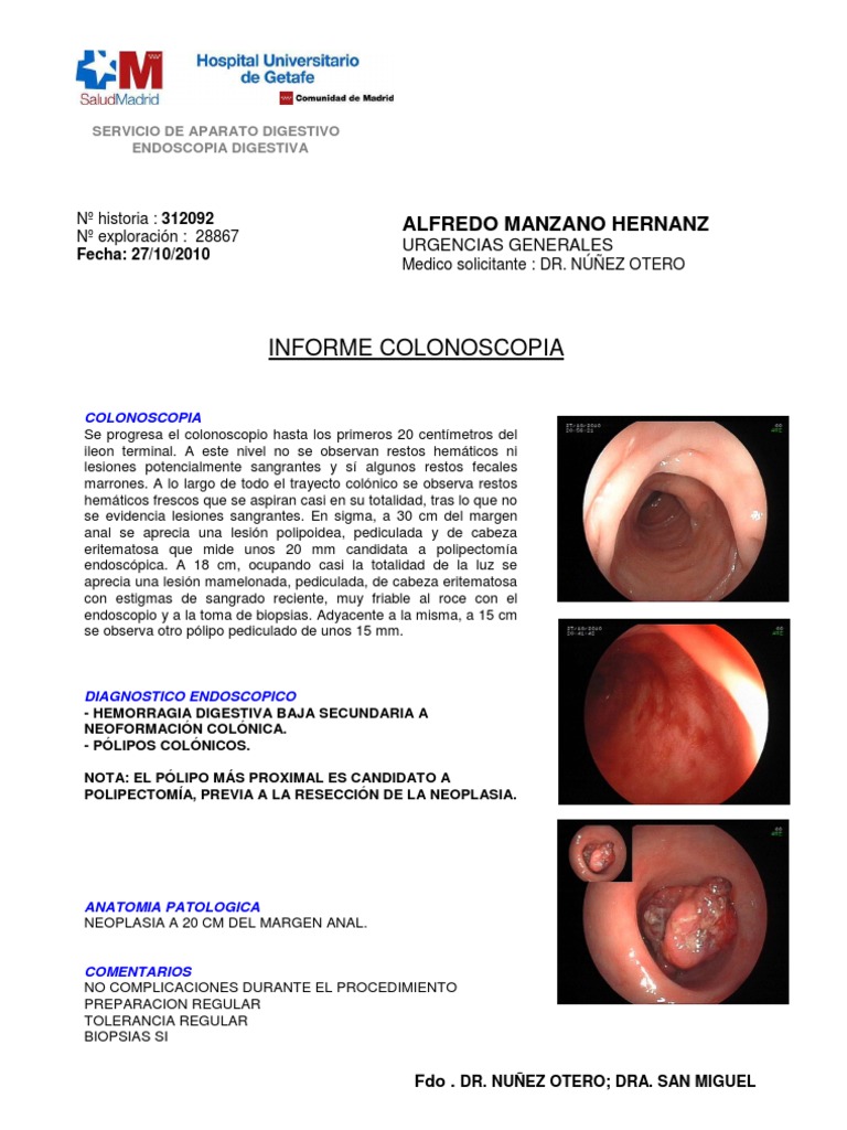 Polipo Pediculado | PDF