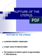 Uterine Rupture