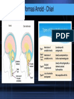 arnold chiari.pptx