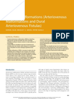 20 Vascular Malformations (Arteriovenous Malformations and Dural Arteriovenous Fistulas)