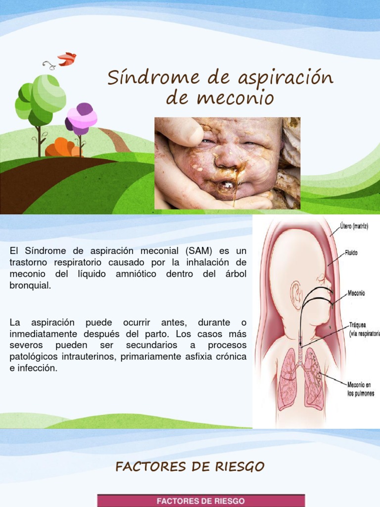 Sindrome de Aspiracion de Meconio PDF Ciencias de la Salud