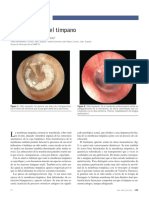 Translucencia tímpano: diagnóstico alteraciones membrana