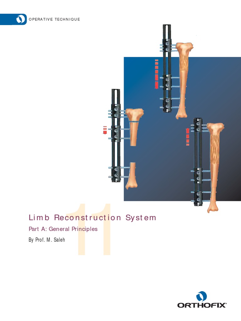 Limb Reconstruction Surgery | PDF | Drill | Screw