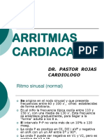 Arritmias Cardiacas