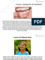 Chipped Tooth Causes Symptoms Treatment