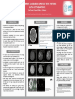 Multiple Brain Abscesses in SLE Patient