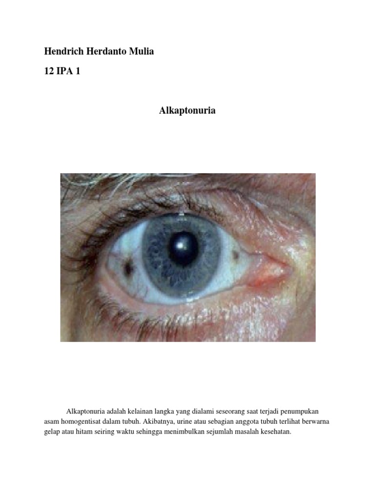 Alkaptonuria | PDF