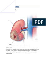 Cáncer de Riñón