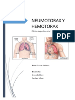 Neumotórax 