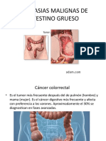 Neoplasias Malignas de Intestino Grueso