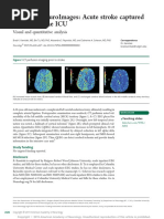 Acute stroke captured__on EEG in the ICU.pdf