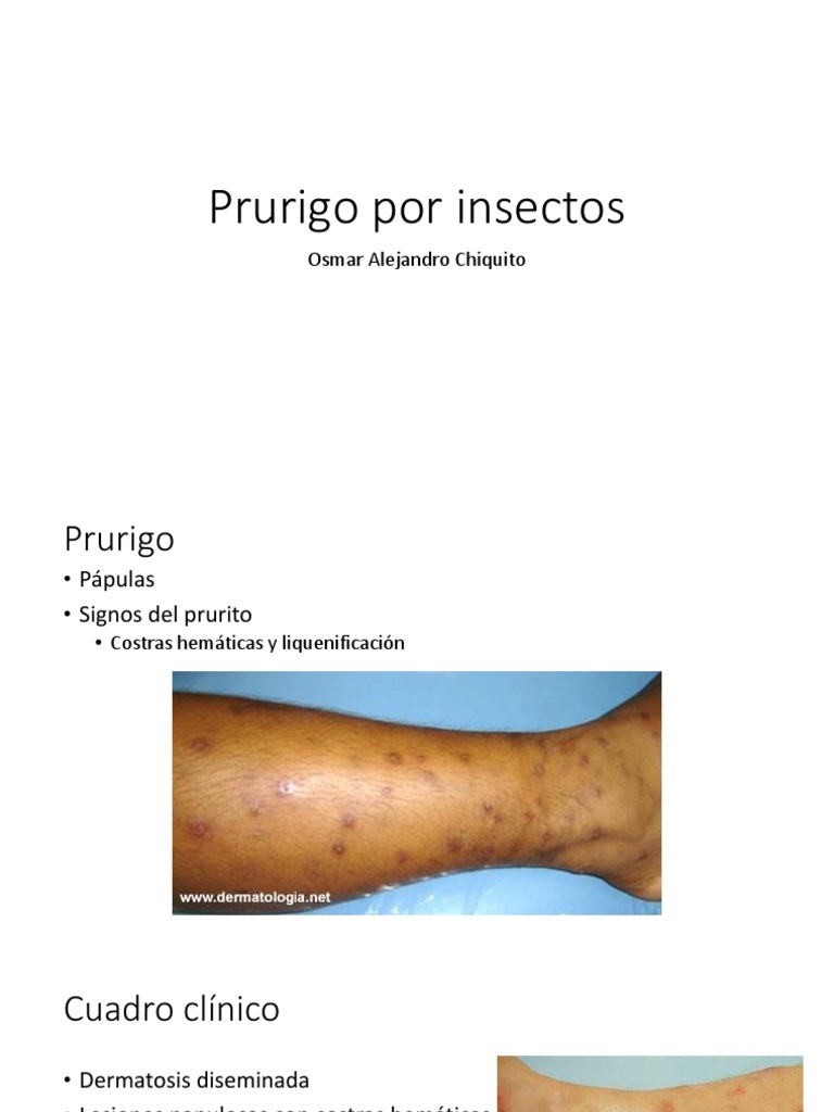Prurigo Por Insectos | PDF