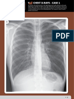 Pneumothorax and lung lesions seen on chest X-rays