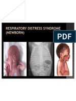 Respiratory Distress Syndrome (Newborn)