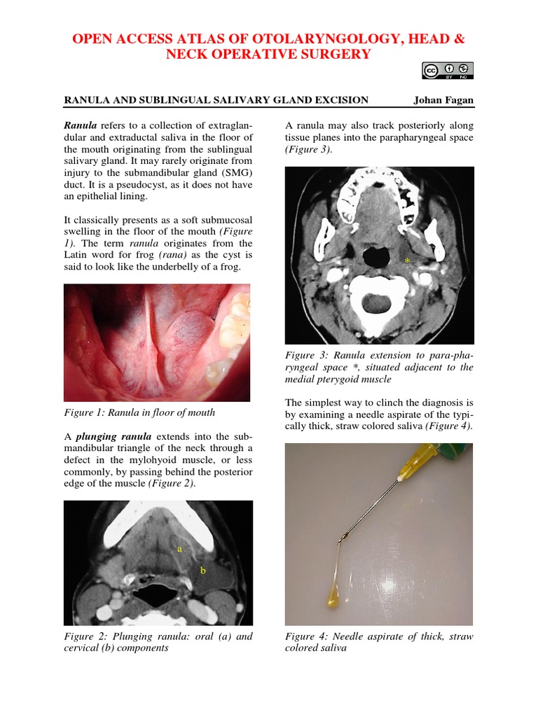Ranula and Sublingual Gland Excision | PDF | Tongue | Glands