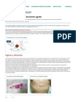 Generalidades Sobre Leucemia Aguda - Hematología y Oncología - Manual MSD Versión para Profesionales