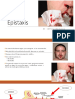 EPISTAXIS