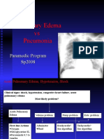 Pulmonary Edema Vs Pneumonia