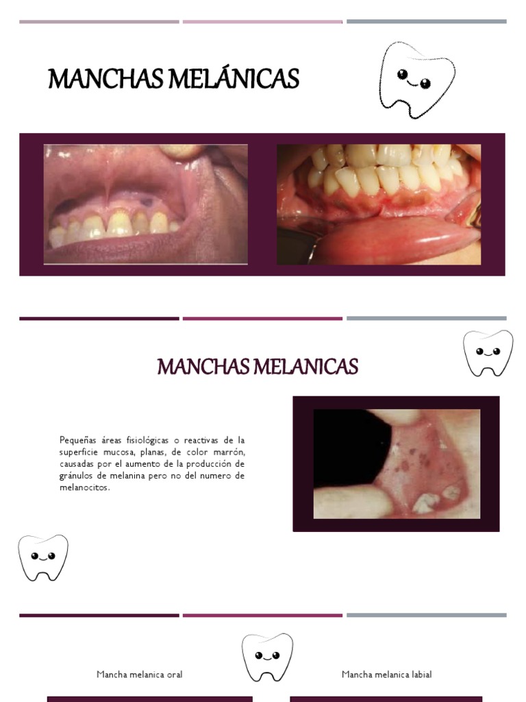 manchas melanoticas Características de las Manchas Melánicas Oral | PDF | Especialidades  Medicas
