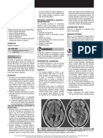 Astrocytoma