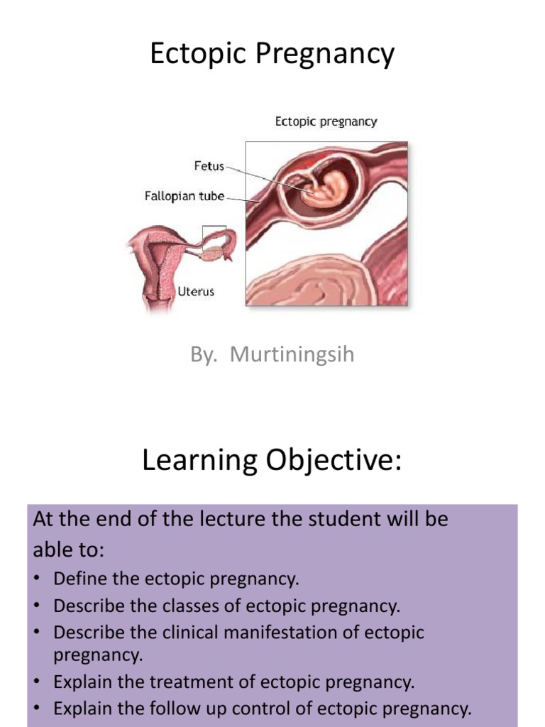 Ectopic Pregnancy PDF Pregnancy Clinical Medicine
