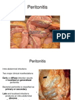 Causes and Symptoms of Peritonitis