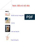 Các bước điều trị nội nha