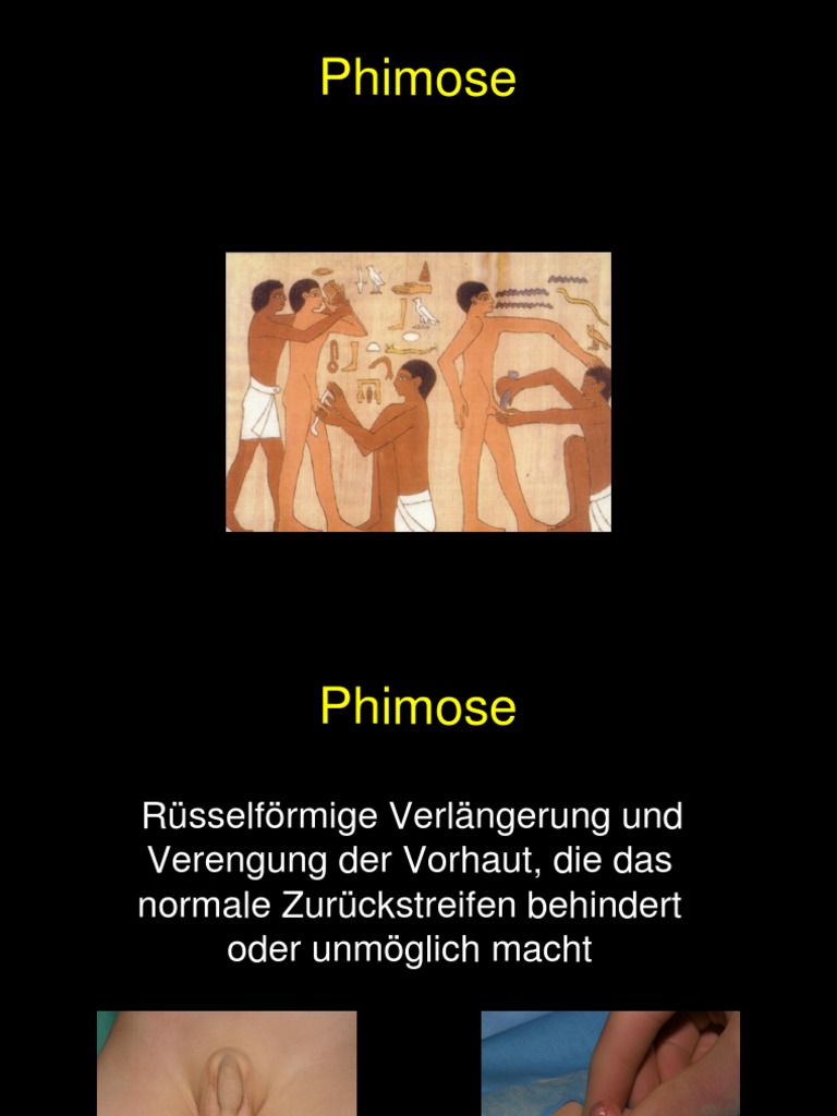 Phimose Category:Phimosis
