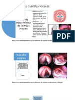 Alteraciones de Cuerdas Vocales