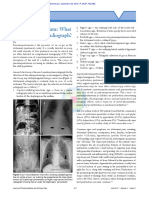 Pneumoperitoneum_What_to_look_for_in_a_radiograph (1)