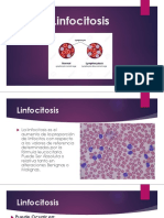 Linfocitosis
