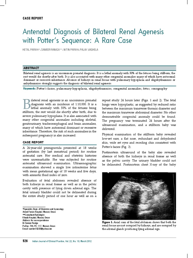 Rare Case of Bilateral Renal Agenesis with Potter’s Sequence PDF
