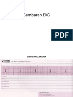 Gambaran EKG