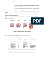 Hernia Nukleus Pulposus Terbagi Dalam 4 Grade