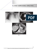 chest radio 3 pleural and subpleural opacities