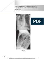 Chest Radio 5 Pleural Thickening and Pleural Calcification