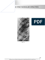 chest radio 17 diffuse fine nodular opacities