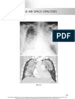 chest radio 15 diffuse air space opacities.pdf