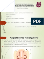 Angiofibromacon Tecnica de Weber
