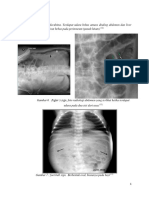 Referat Radiologi Peritonitis