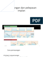 Pemasangan Dan Pelepasan Implan