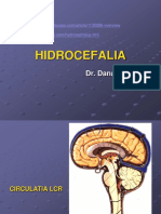 3.3. Hidrocefalia