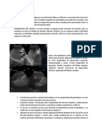 Cirrosis Hepática