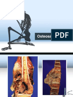 Osteosarkom