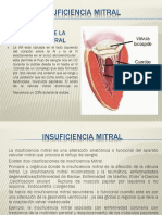 Insuficiencia Mitral