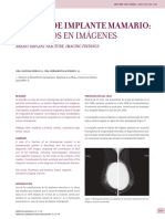 Rotura de Implante Mamario Hallazgos en Imagenes