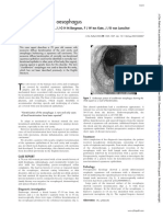 A ‘‘crackleware’’ oesophagus.pdf